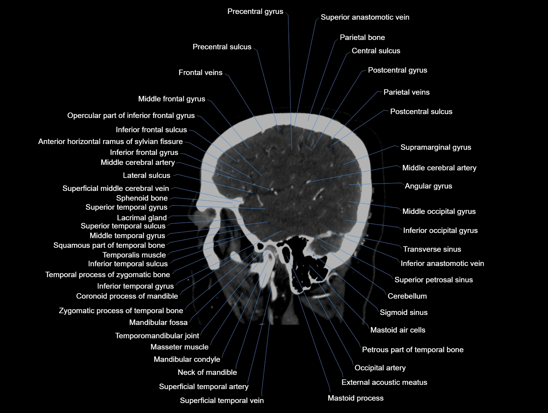 CT scan brain sagittal cross sectional anatomy image-img-00001-00016.webp
